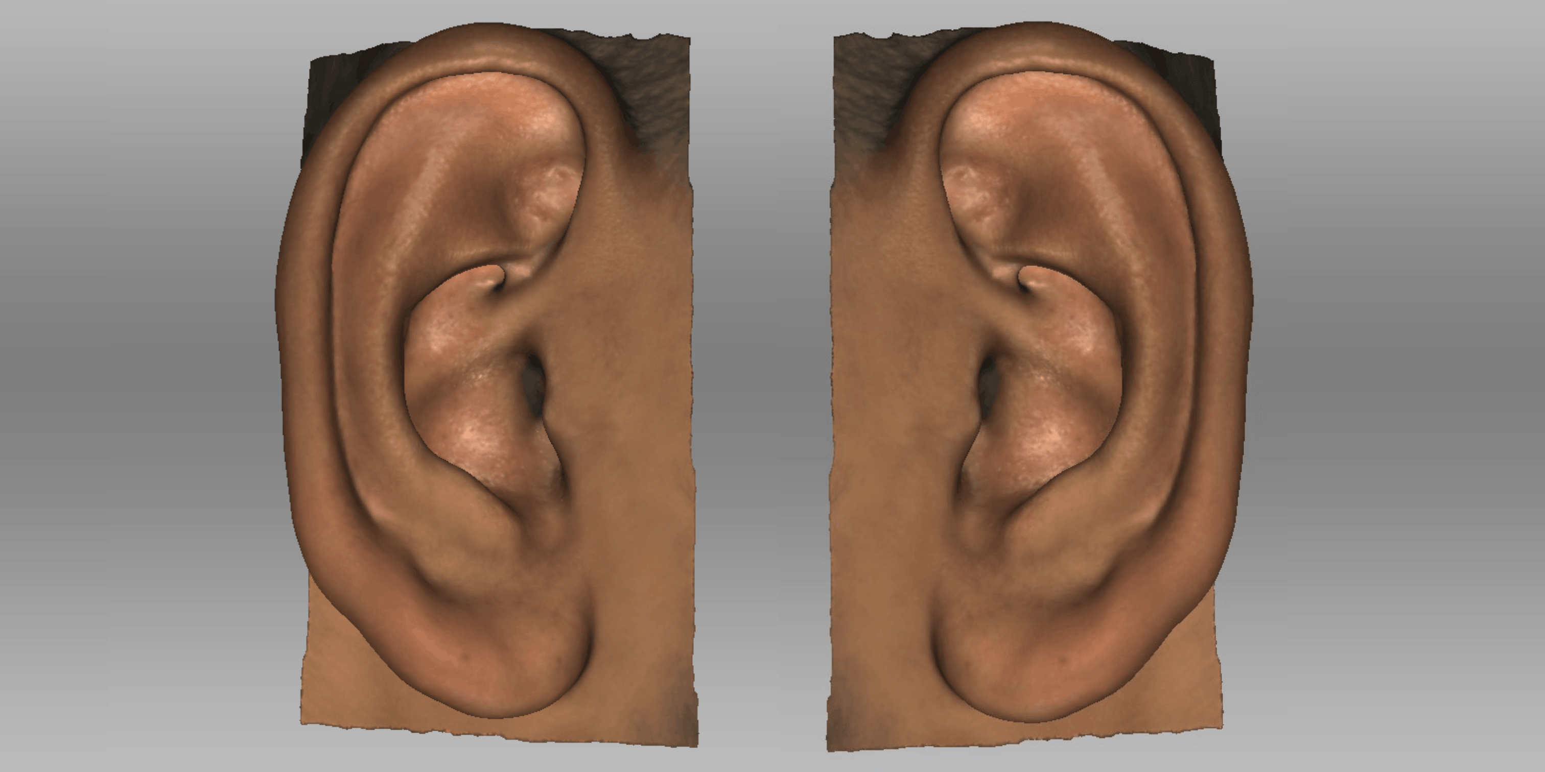 3D Scanning for Ear Reconstruction